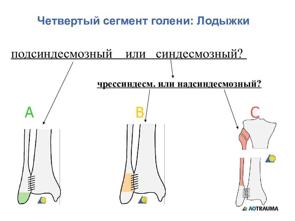 Переломы лодыжек травматология презентация