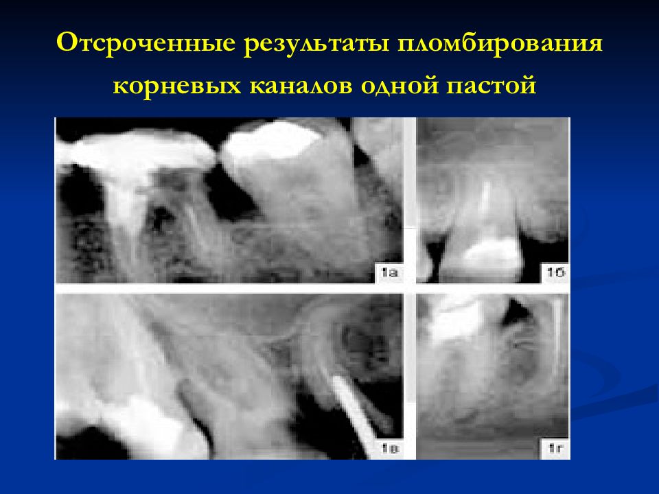 Постоянное пломбирование корневого канала