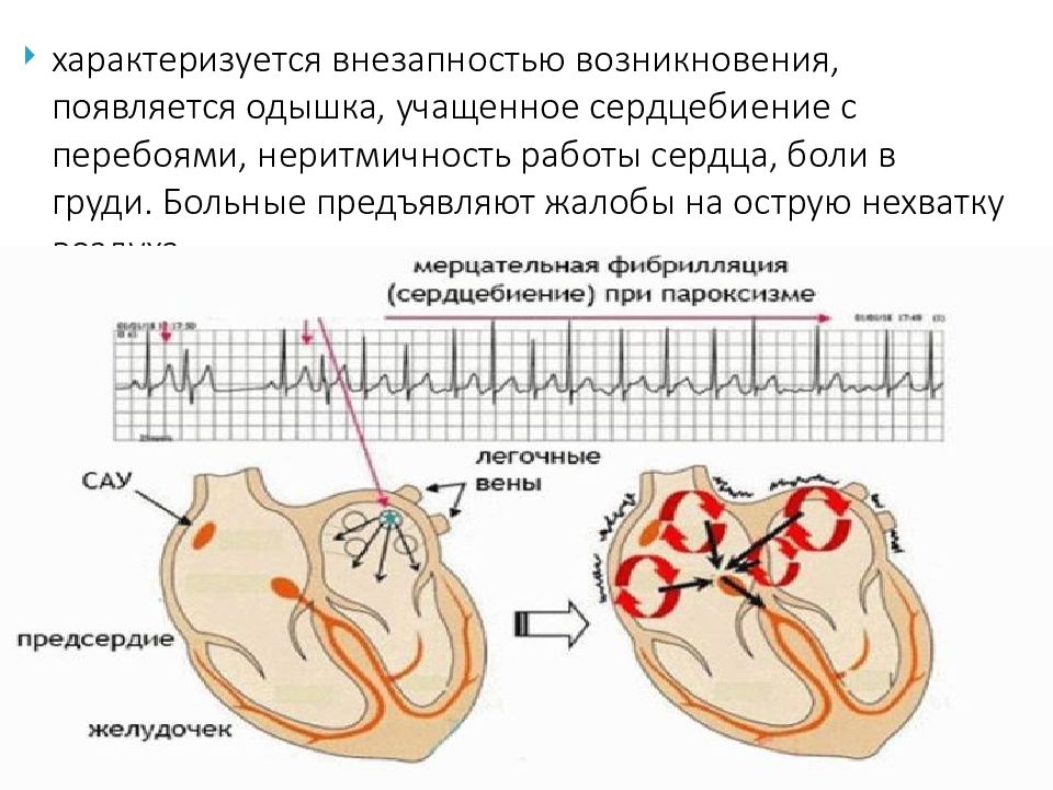 физкультура при мерцательной аритмии сердца. экстрасистолия терапия. аритмия после еды. диета при мерцательной аритмии. аритмия после еды.