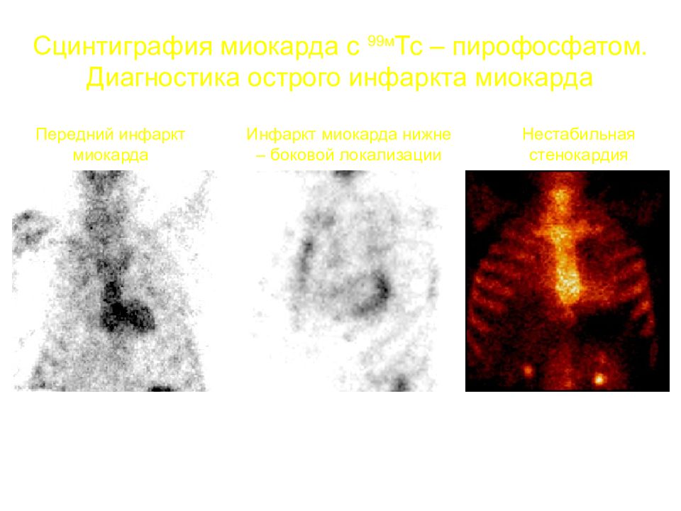 Презентация сцинтиграфия миокарда