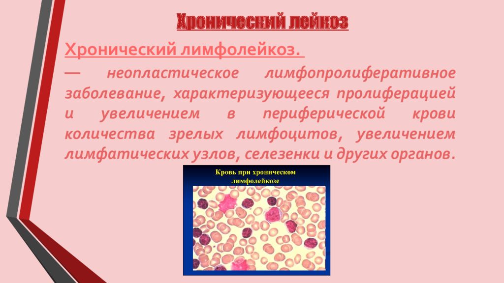 Лейкоз прошел. В -лимфоциты хронический лимфолейкоз. Хронический лимфолейкоз характеризуется. Хронический лимфолейкоз периферическая кровь. Хронический лимфолейкоз лимфоузлы.