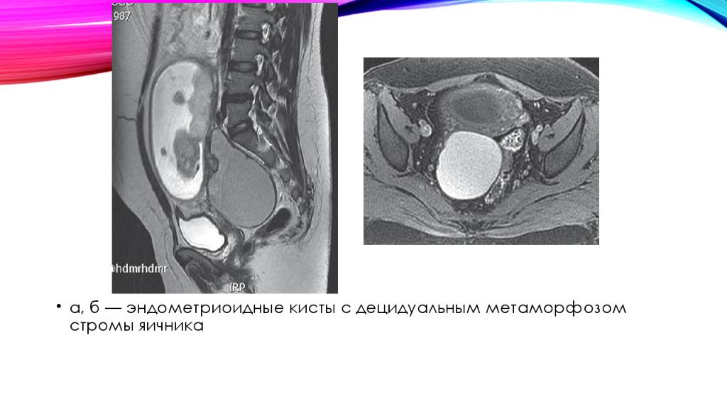 Эндометриозная киста. Эндометриоидная киста кт. Эндометриома яичника мрт. Дермоидная киста яичника кт. Эндометриоидная киста яичника мрт.