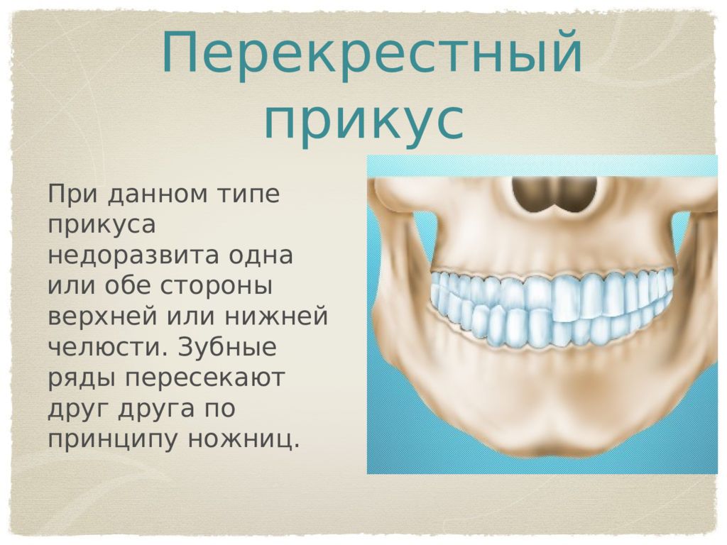 Прикус. Перекрестный прикус со смещением нижней челюсти в сторону. Перекрестный прикус сужение верхней челюсти. Глубокий перекрестный прикус.