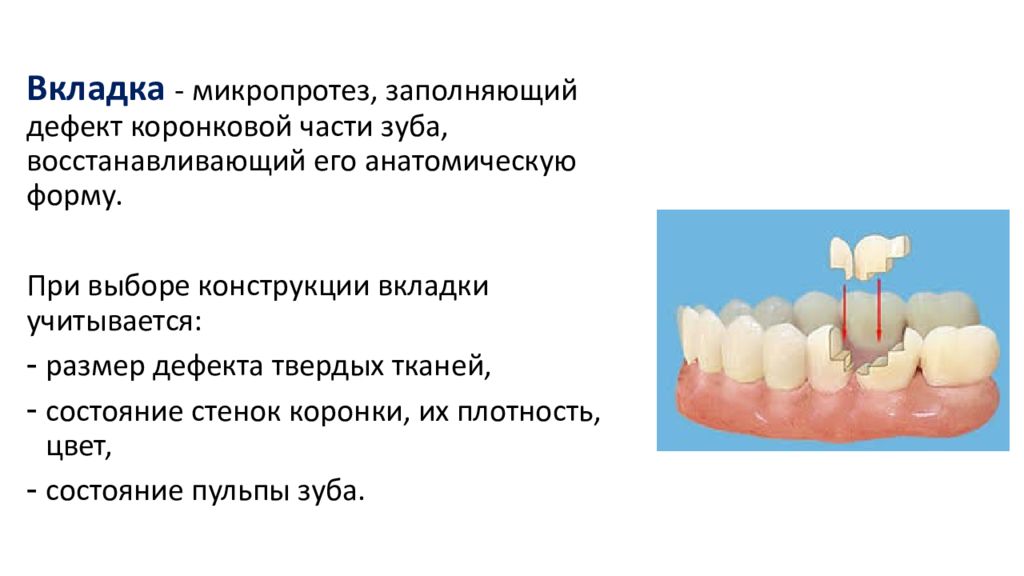 Вкладки ортопедическая стоматология презентация