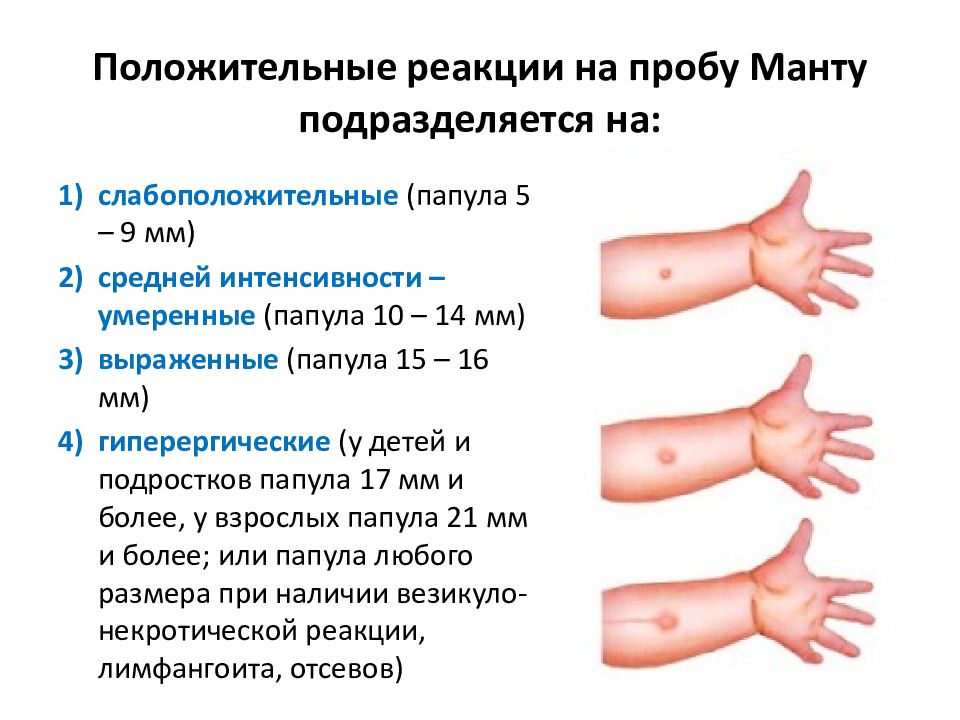 Диаскинтест результаты