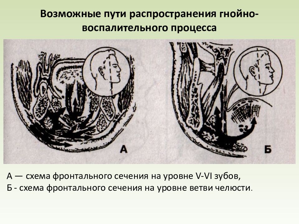 Абсцесс и флегмона поднижнечелюстной области презентация