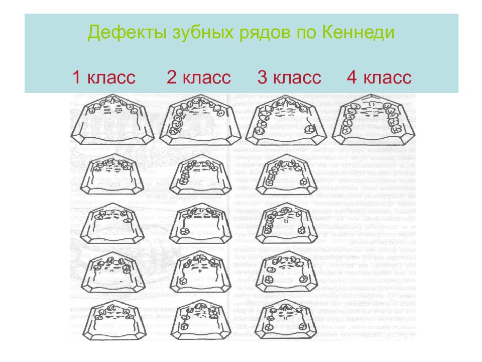 Обследование пациентов с обширными дефектами зубных рядов презентация