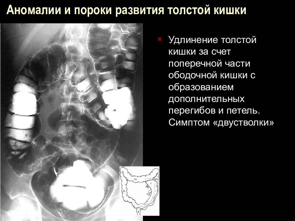 Дефект кишечника. Пороки развития толстой кишки этиология. Аномалии ободочной кишки. Аномалии развития Толстого кишечника.