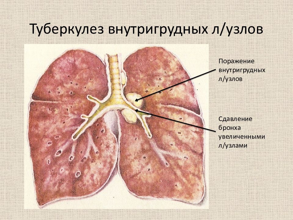 Первичный туберкулез картинки