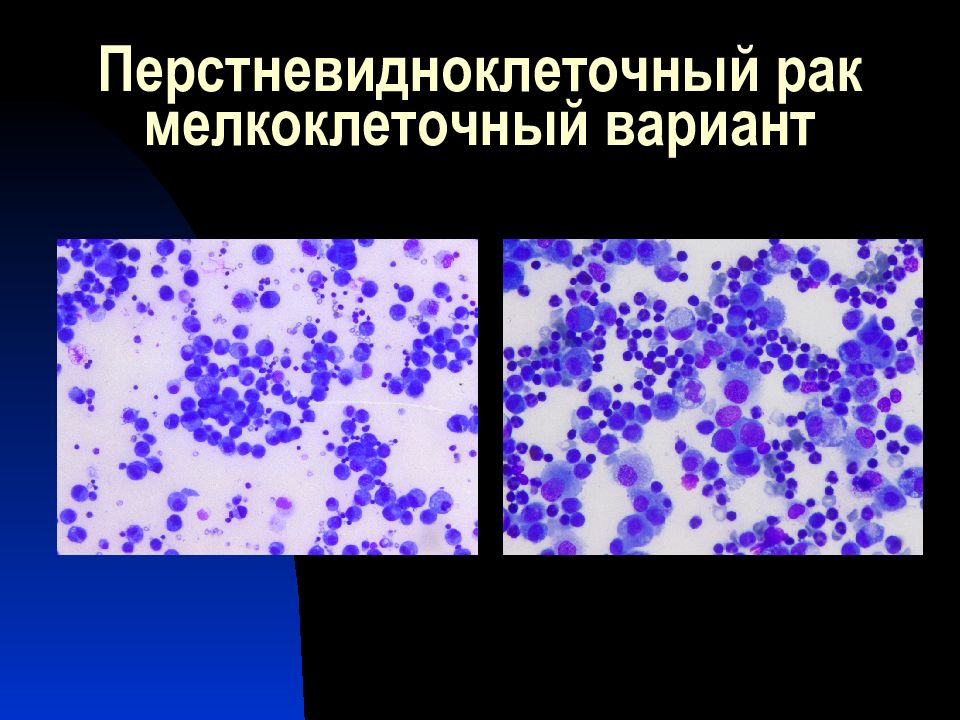 Мелкоклеточный рак прогноз. Исследование выпотных жидкостей. Микроскопия выпотных жидкостей. Современные методы исследования выпотных жидкостей. Исследование окрашенных препаратов выпотных жидкостей.