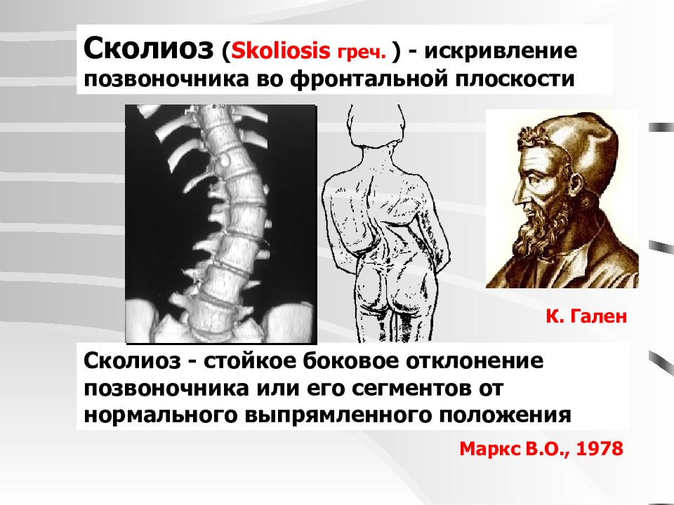 Фронтальная плоскость позвоночника. Искривление позвоночника. Искривление позвоночника во фронтальной плоскости. Сколиоз презентация для детей. Сколиоз деформация во фронтальной плоскости.