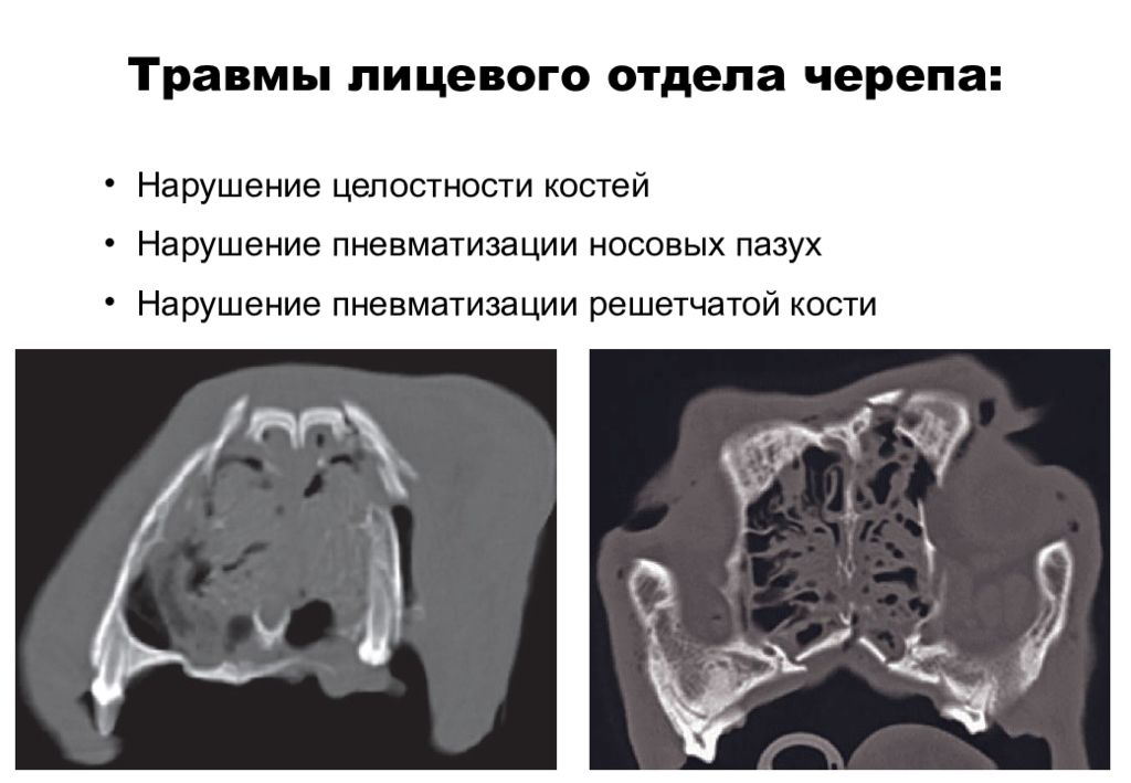 Кт лицевых костей. Снижена пневматизация решетчатой кости. Компьютерная томография костей лицевого отдела черепа. МСКТ лицевого отдела черепа. Кт компьютерная томография черепа.