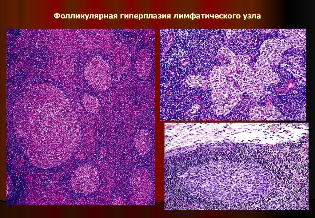 Гиперплазия лимфатического узла микропрепарат. Реактивная гиперплазия лимфоузла микропрепарат. Реактивная гиперплазия лимфатического узла гистология. Фолликулярная гиперплазия. Гиперплазия лимфоузлов у детей