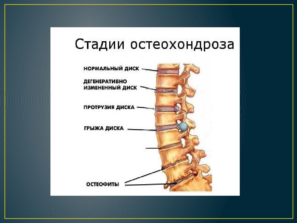 Остеохондроз годность