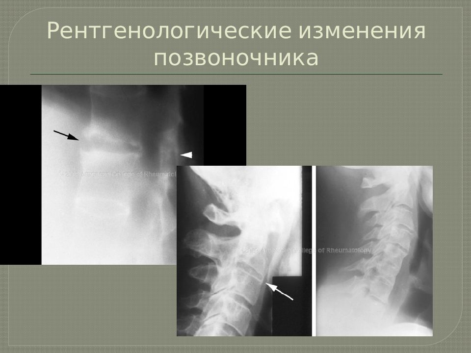 Анкилозирующий спондилит презентация