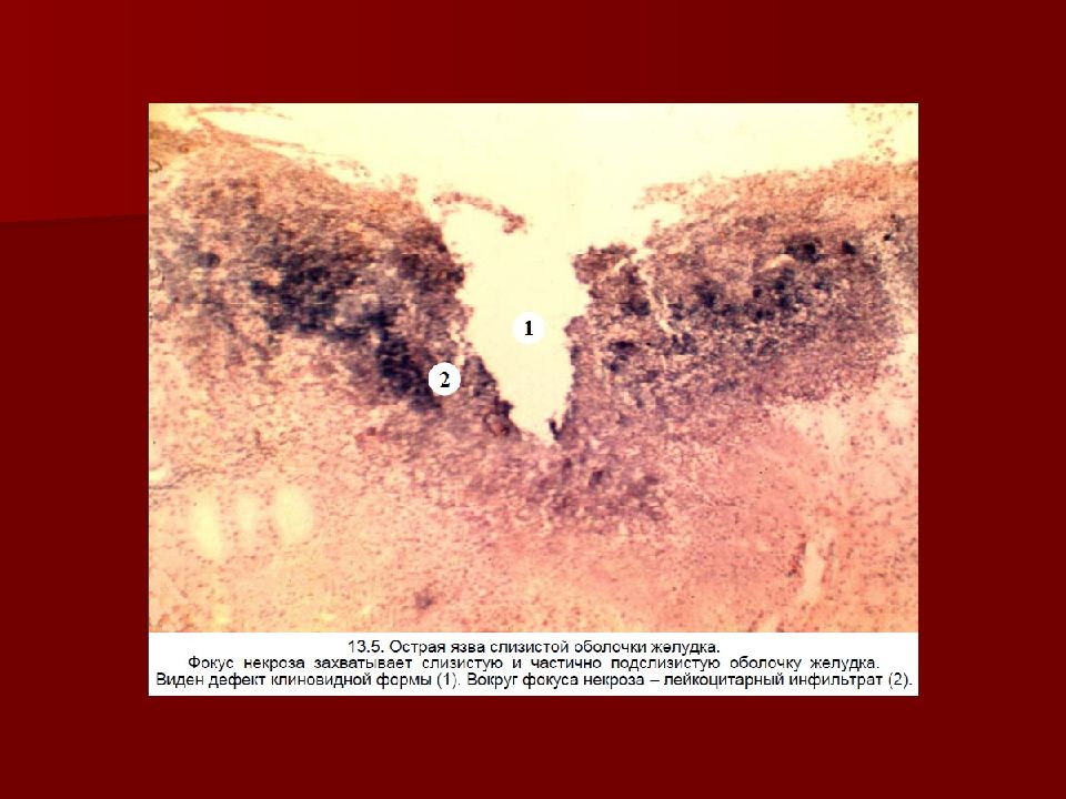 Хроническая язва желудка микропрепарат рисунок