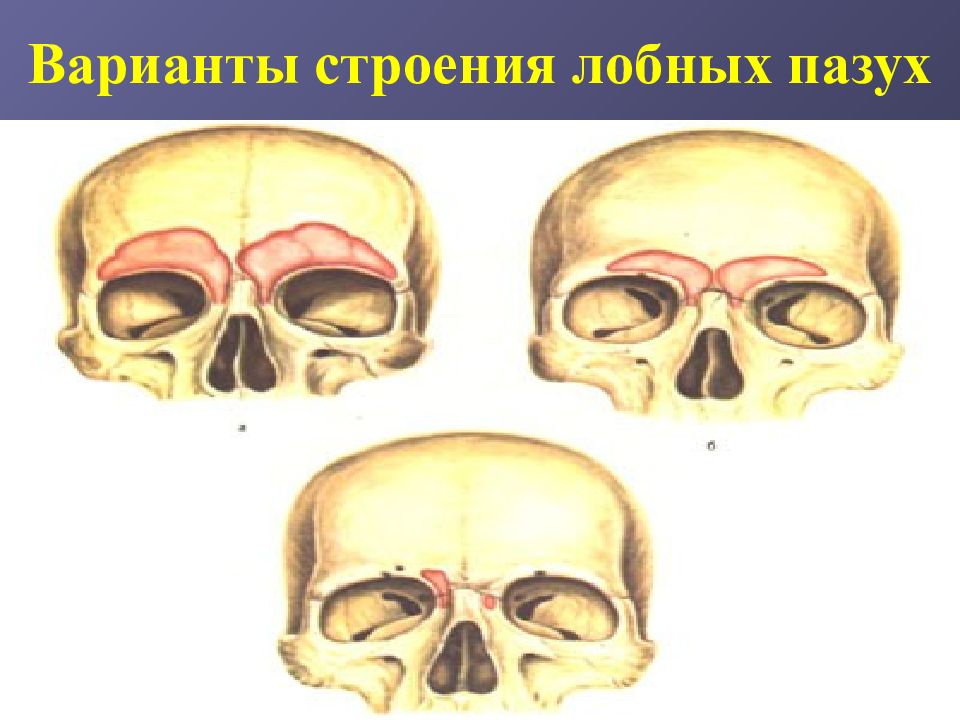 Лобная пазуха. Строение черепа лобные пазухи. Лобные пазухи черепа анатомия. Лобная пазуха анатомия на лобной кости. Лобная пазуха топографическая анатомия.