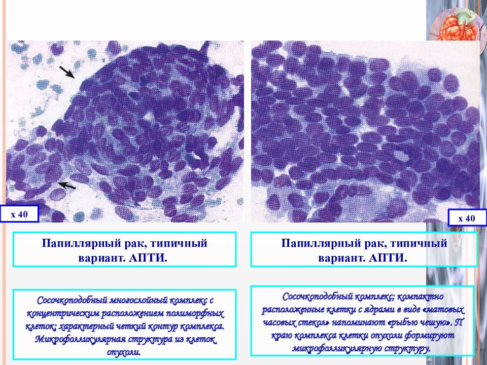 Цитологическая картина папиллярной карциномы щитовидной железы