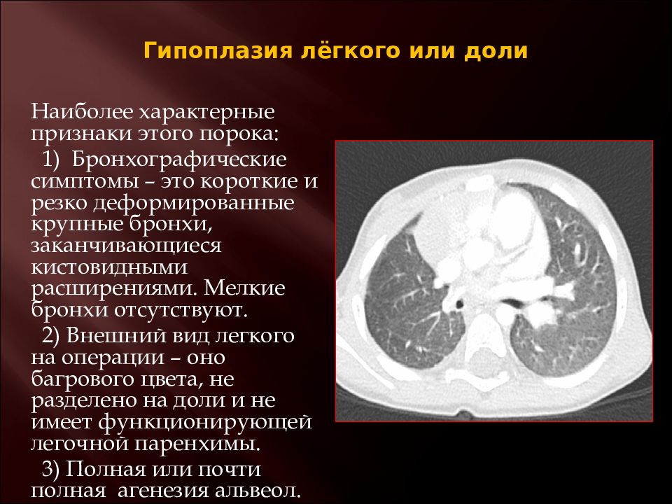 Гипоплазия синуса. Легочная гипоплазия кт. Гипоплазия доли легкого. Аномалии развития легких кт.