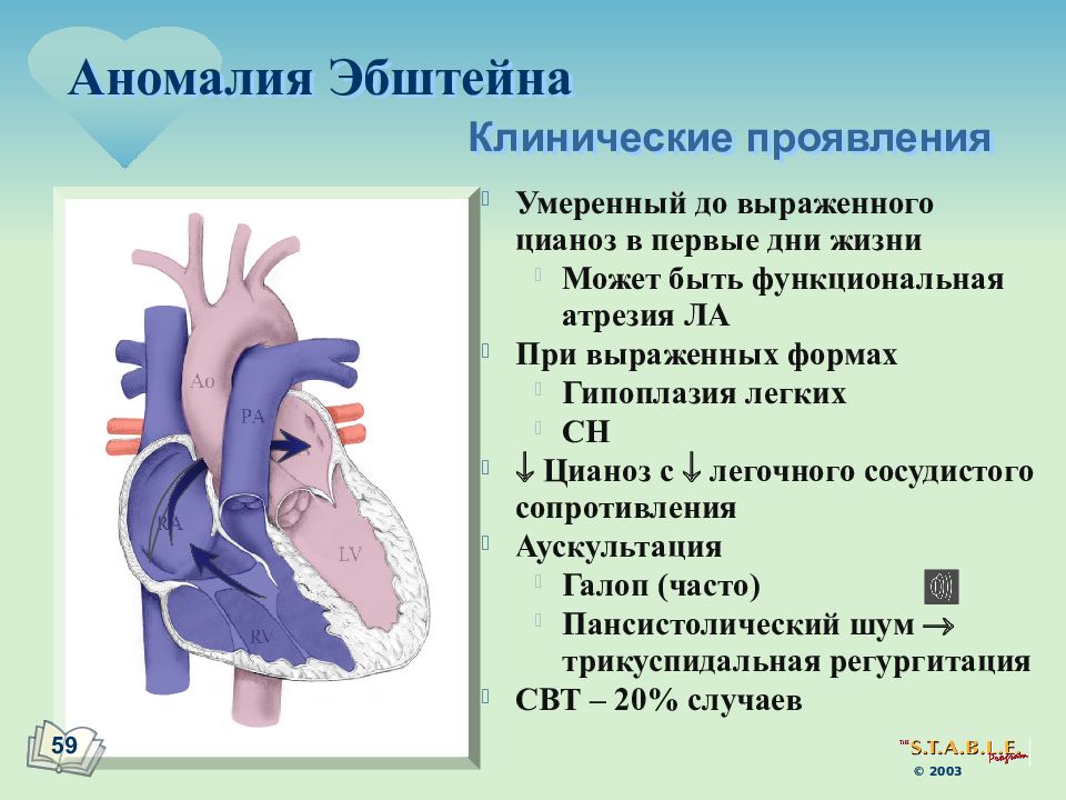 При аномалии эбштейна легочный рисунок