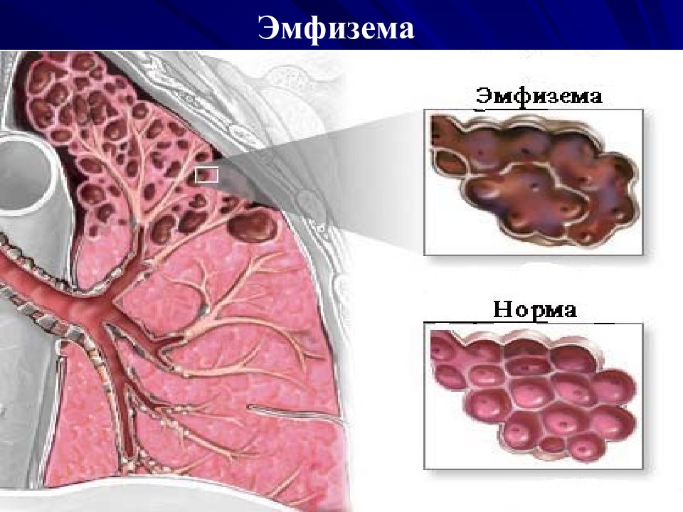 Эмфизема легких картинки