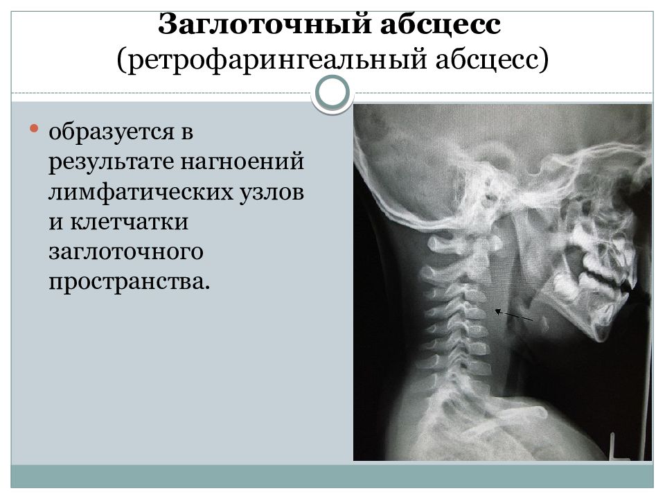 Заглоточный абсцесс. Ретрофарингеальный абсцесс. Ретрофарингеальный (заглоточный) абсцесс. Реирофарингиалный абсецц.