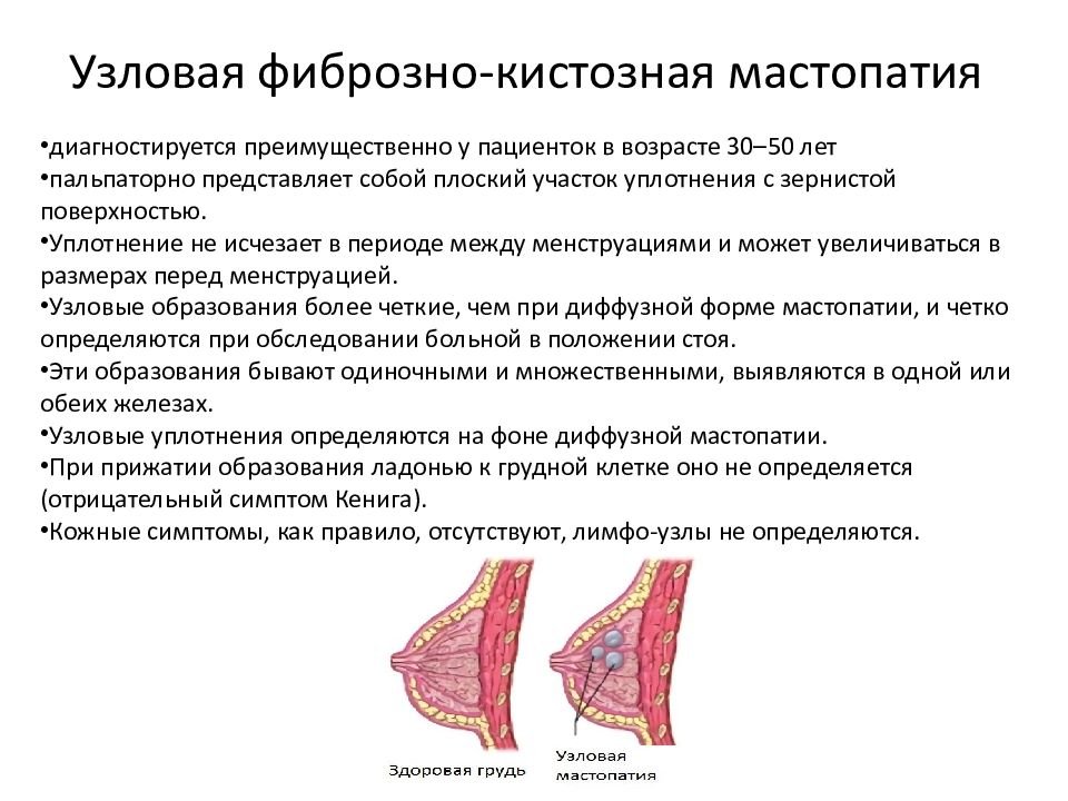 Фиброзно кистозная мастопатия молочных желез. Фиброзно-кистозная мастопатия молочных желез Узловая мастопатия. Узловая форма фиброзно-кистозной мастопатии. Узловая фиброзно-кистозная мастопатия. Фиброзно Узловая мастопатия молочной железы.