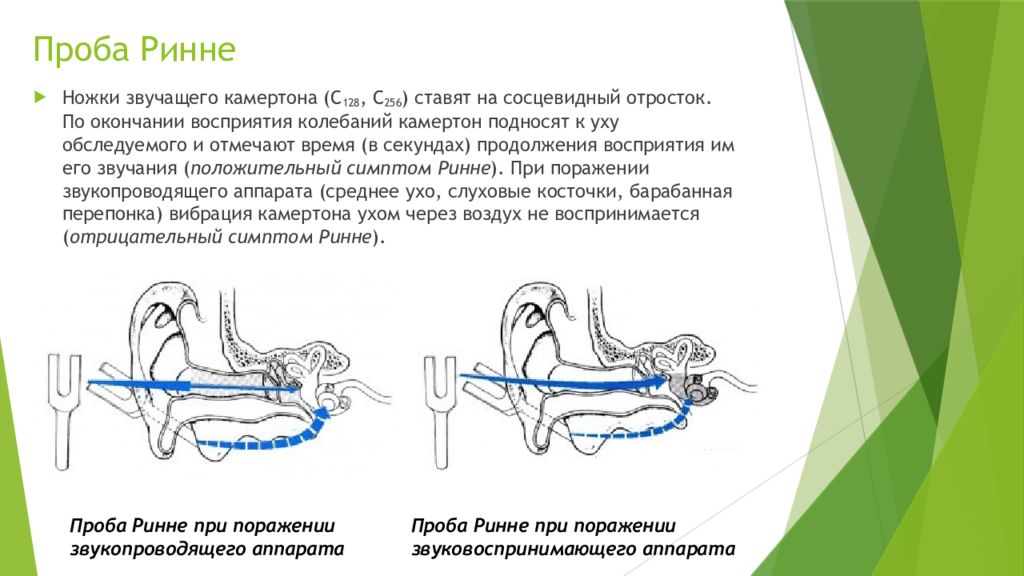 Проба вебера. Опыт Ринне в норме. Исследование слуха камертонами норма. Исследование слуховой функции камертонами. Проба Вебера слух.