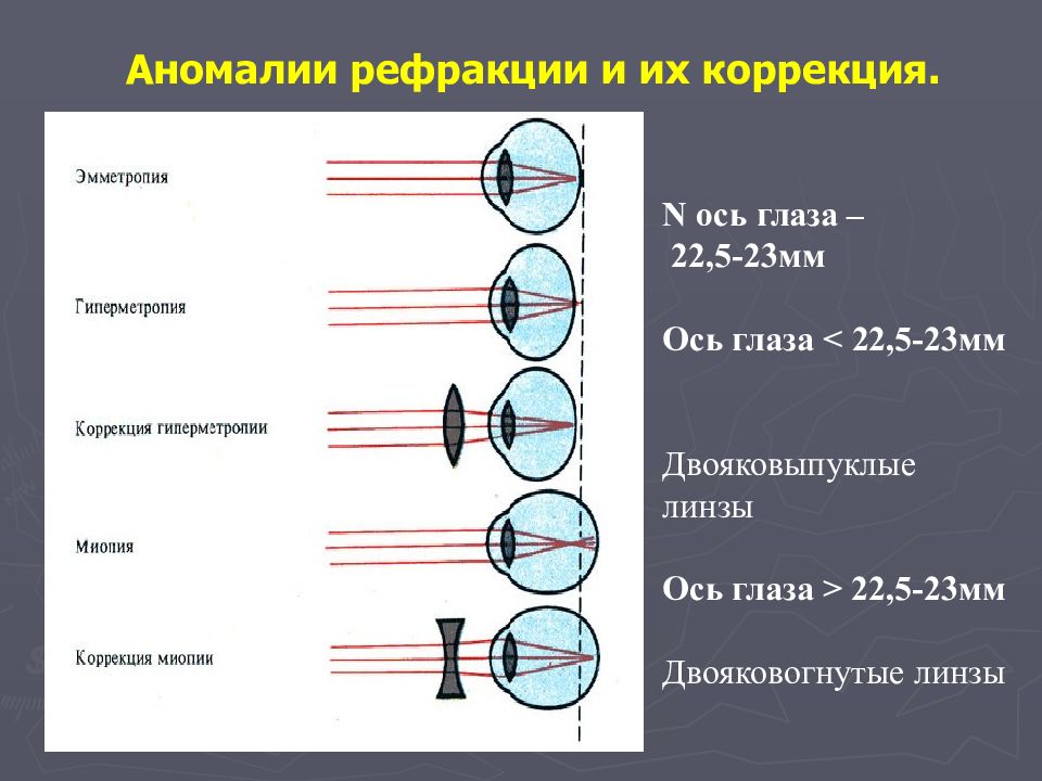 Схема хода лучей в глазе при близорукости