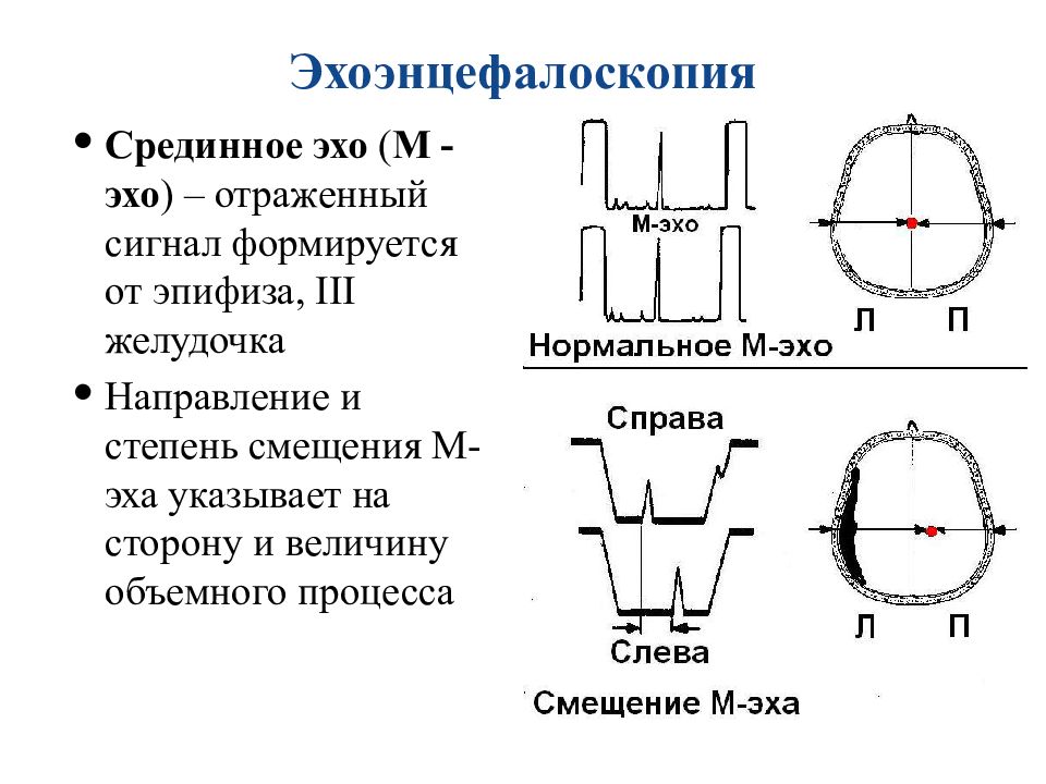 Эхом отражается. Срединное м-Эхо что это. Эхоэнцефалоскопия. Эхоэнцефалоскопия в норме. Эхоэнцефалоскопия при опухолях.