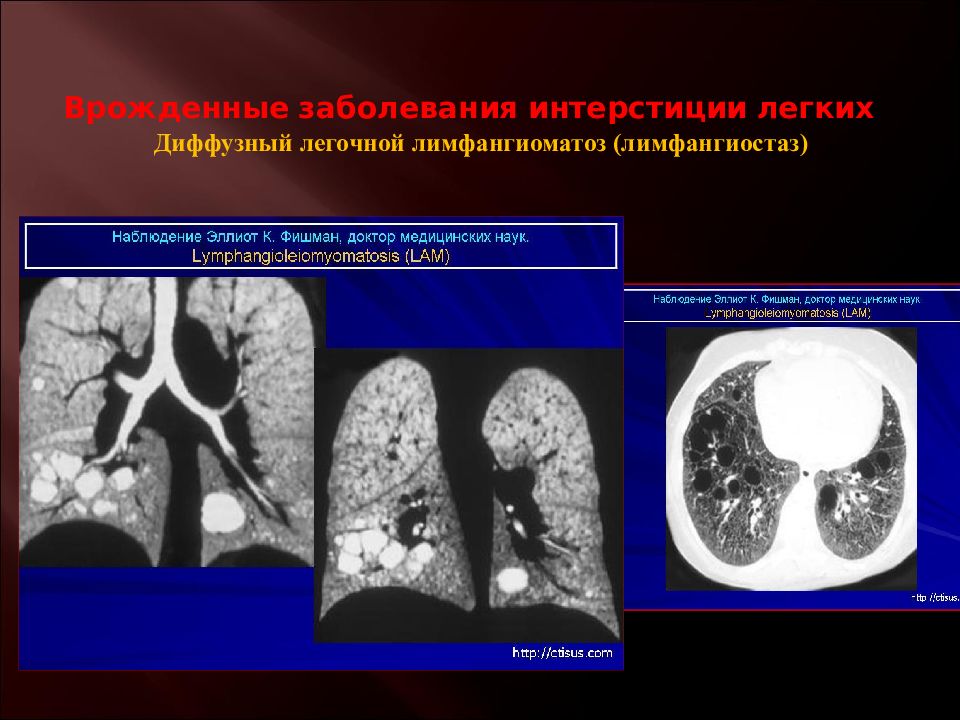 Врожденные заболевания. Интерстиций легких. Врожденныезоболевания легких. Интерстиции легких это. Врожденные заболевания легких.
