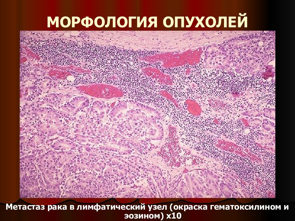 Метастаз рака в лимфатический узел. Мелкоацинарная аденокарцинома гистология. Ацинарная аденокарцинома простаты гистология. Метастазы в лимфоузлах микропрепарат. Метастазы в лимфатическом узле микропрепарат.