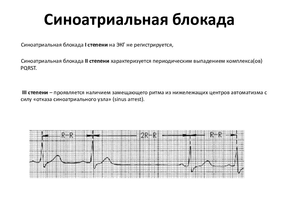 Синоатриальная блокада 2 степени 2 типа