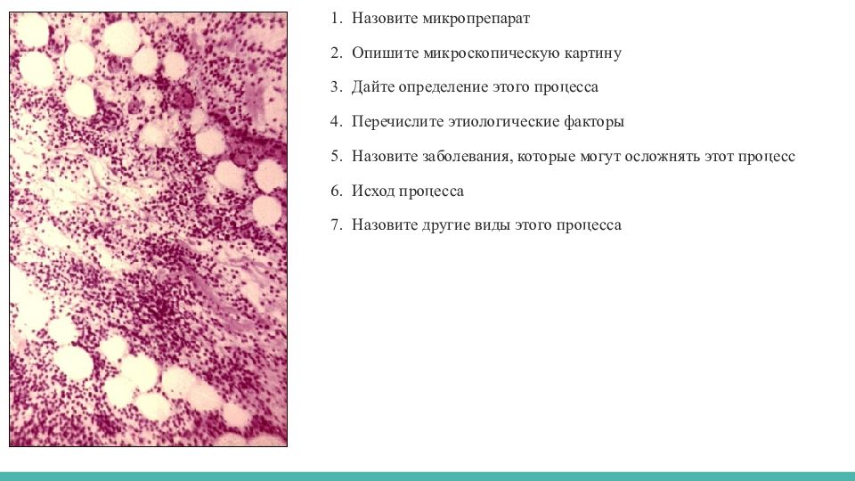 Описание микропрепарата. Струма Хашимото микропрепарат. Аутоиммунный тиреоидит Хашимото микропрепарат описание. Хронический иммунный тиреоидит микропрепарат. Зоб Хашимото микропрепарат.