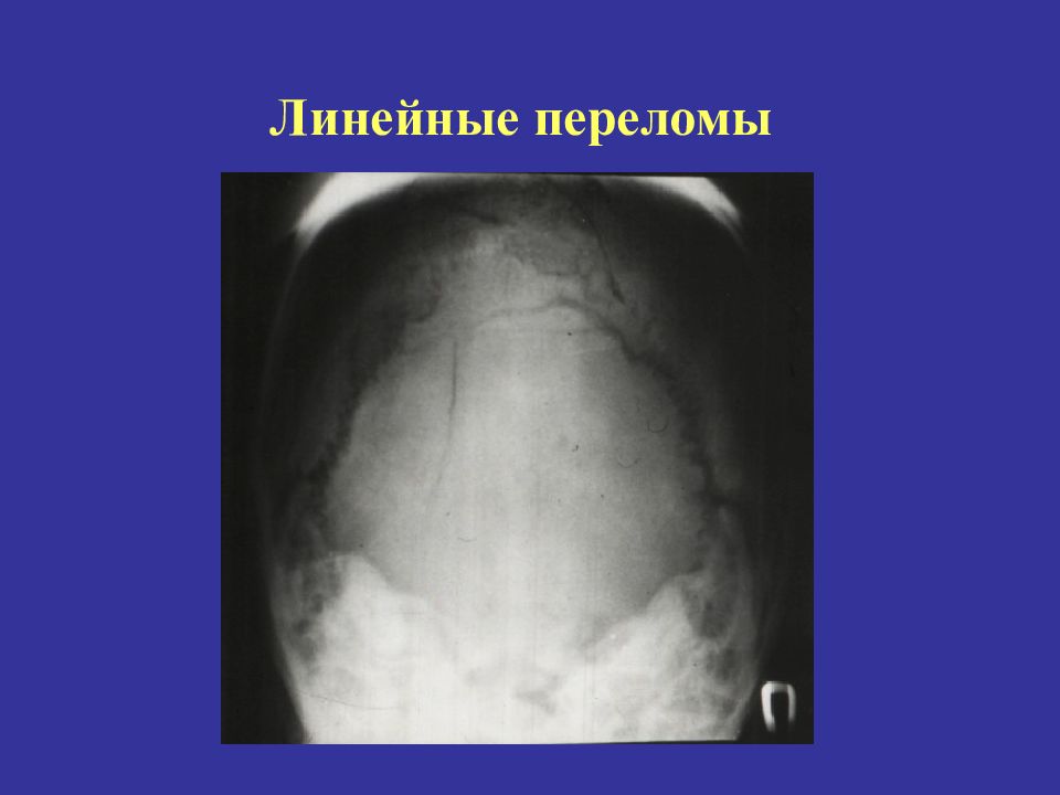 Линейная трещина. ЧМТ лучевая диагностика. Линейный перелом лучевой.