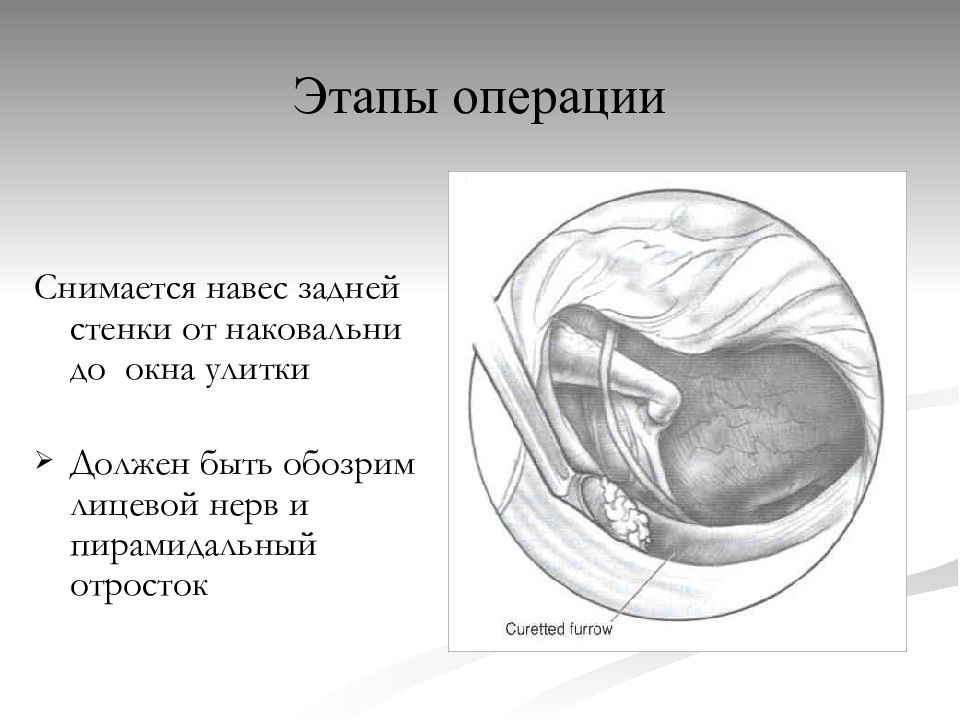 Парацентез барабанной перепонки. Парацентез барабанной перепонки техника операции. Пирамидальный отросток ухо. Парацентез барабанной перепонки осуществляется в квадранте.