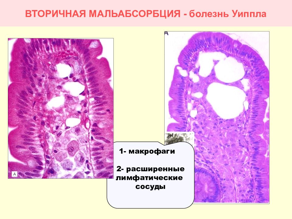 Болезнь уиппла картинки