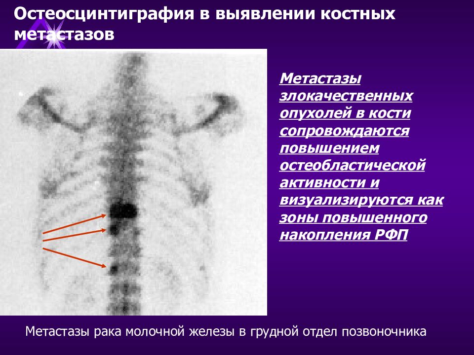 Гиперфиксация рфп что это такое. Остеосцинтиграфия при метастазах в костях. Метастазы в кости грудной клетки. Накопление РФП В костях что это. Радионуклидная визуализация скелета.