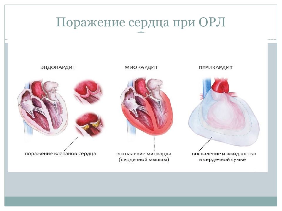 Острая ревматическая лихорадка клиническая картина