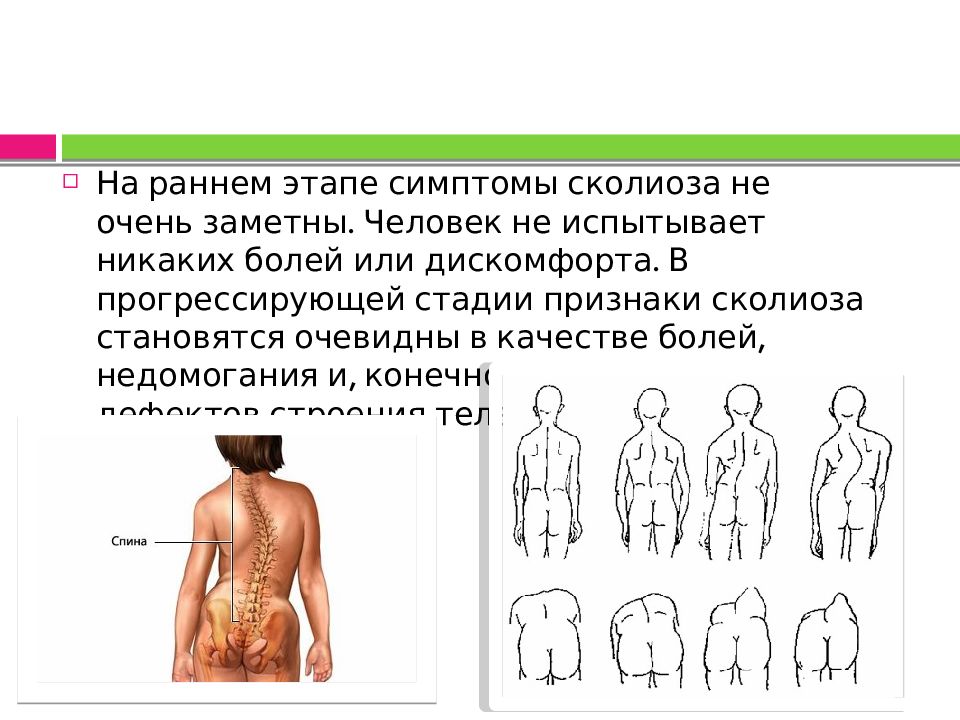 Ли сколиоз. Признаки искривления позвоночника. Искривление позвоночника симптомы. Симптомы сколиоза у детей. Причины появления сколиоза у человека.