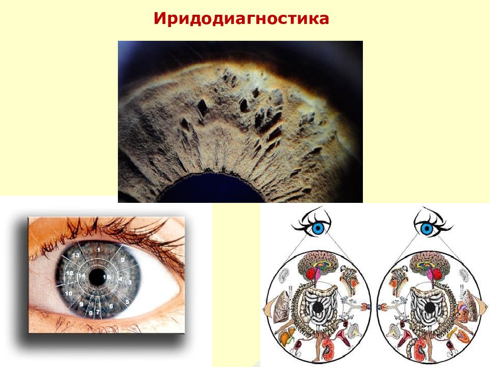 Иридодиагностика фото с расшифровкой