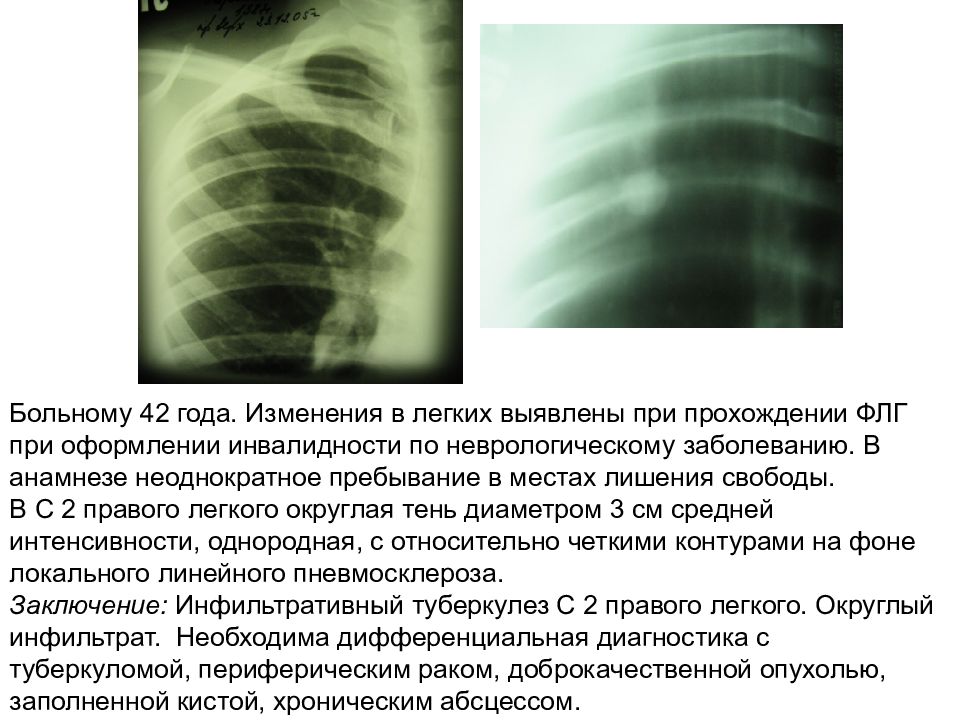 атеросклероз дуги аорты рентген. изменения при туберкулёзе на флг. аневризма восходящей аорты рентген. атеросклероз аорты сердца что это такое симптомы лечение. рентген уплотнение корня лёгкого.