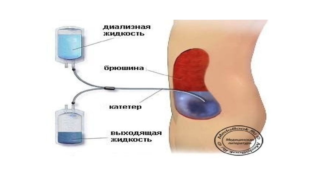 Клинический диализ. Перитонеальный катетер для диализа. Проточный перитонеальный диализ у новорожденных. Диализ брюшной полости. Перитонеальный диализ презентация.