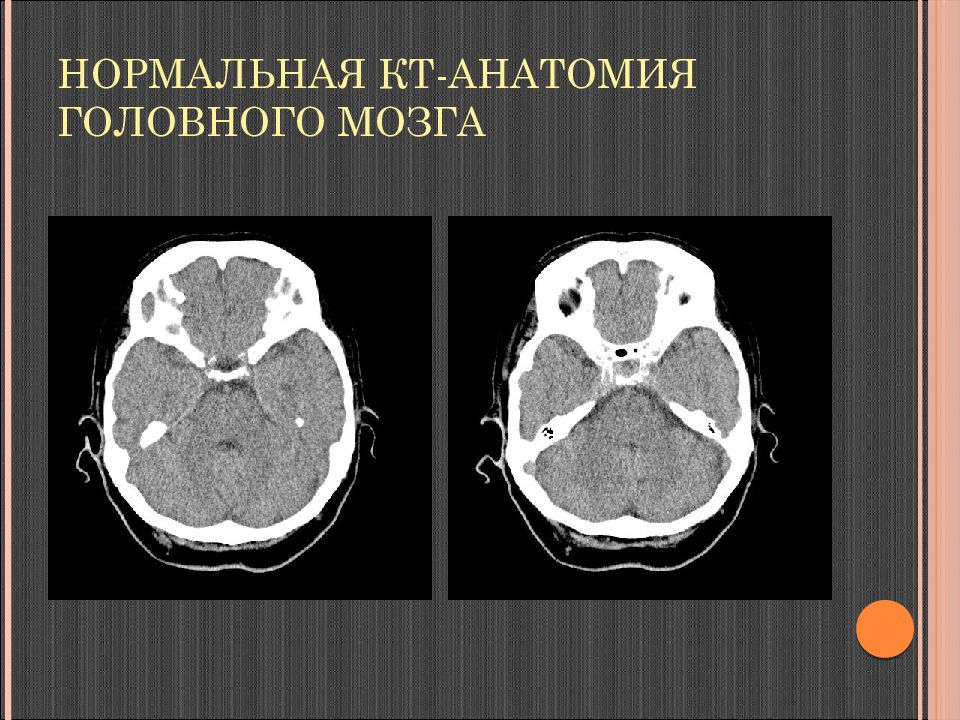 Секционная анатомия кт. Анатомия головного мозга на кт срезах. Строение головного мозга на кт. РКТ головного мозга анатомия. Нормальная кт анатомия головного мозга.