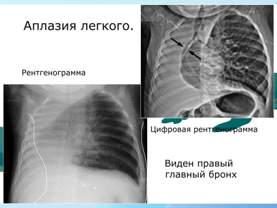 Врожденные пороки развития дыхательной системы презентация