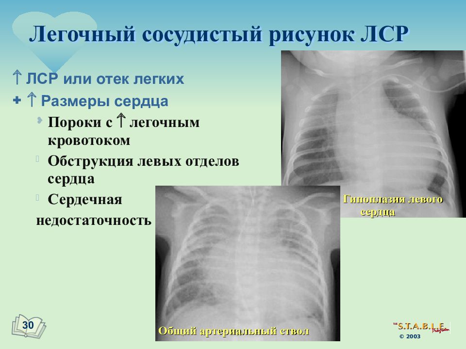 Усилен сосудисто легочный рисунок. Легочный и сосудистый рисунок. Сосудистый рисунок легких. Сосудистое рисунок лешктх. Усиленный сосудистый рисунок легких.