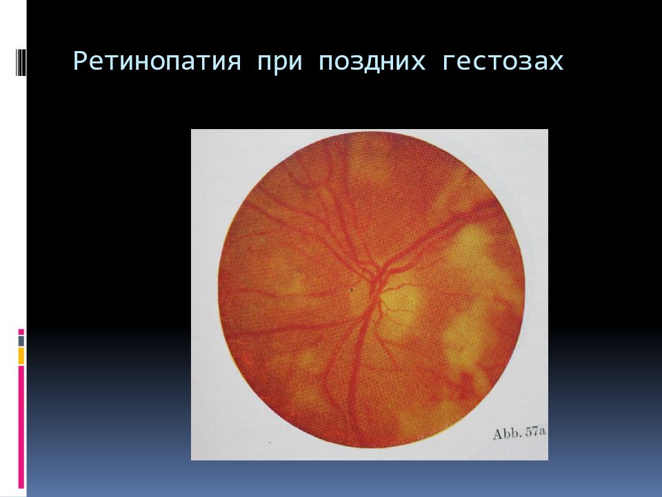 Заболевания сетчатки и зрительного нерва офтальмология презентация