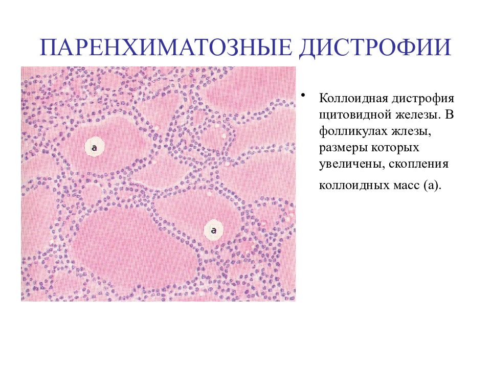 Скопление клеток фолликулярного эпителия. Паренхиматозный зоб гистология. Паренхиматозный зоб микропрепарат. Паренхиматозные дистрофии микропрепарат. Микрофолликулярный зоб микропрепарат.