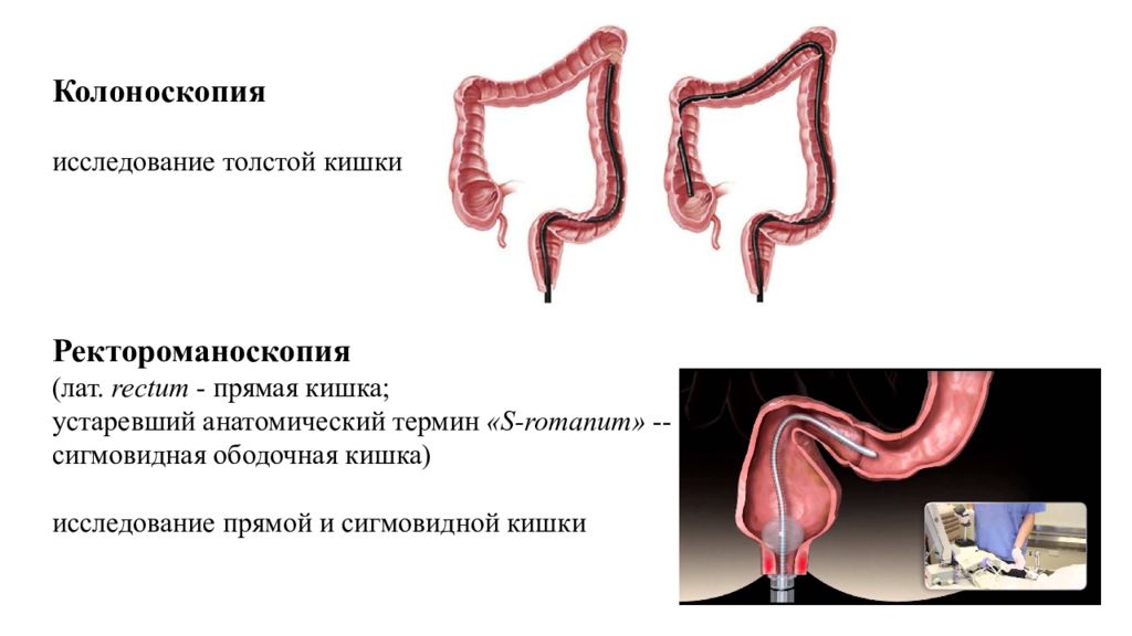 Исследование прямой кишки колоноскопия