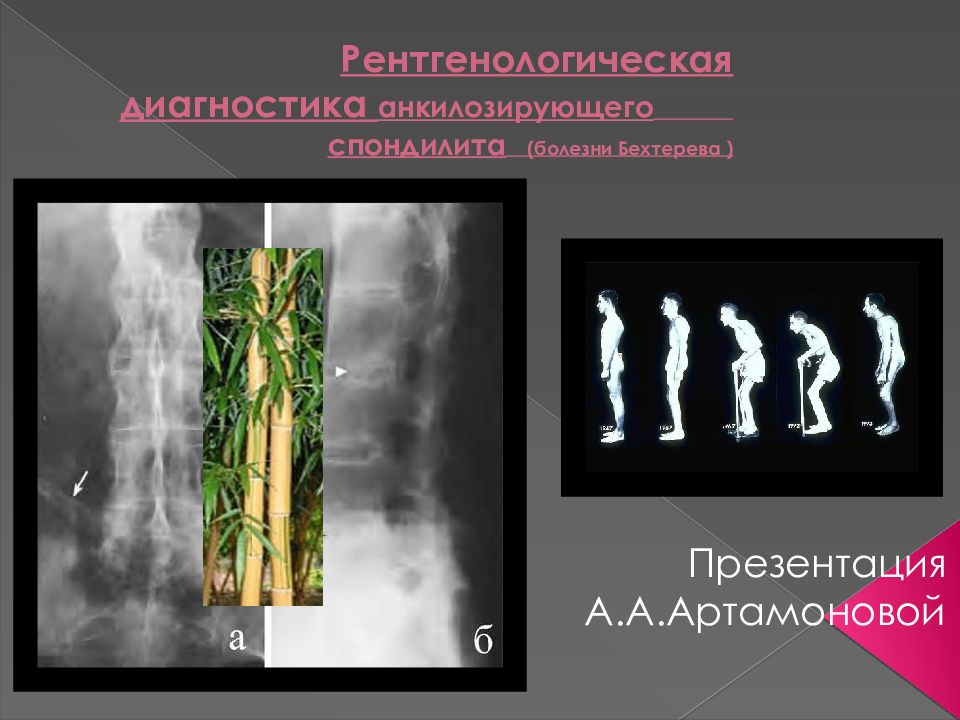 Рентгенологическая диагностика анкилозирующего спондилита (болезни Бехтерева )
